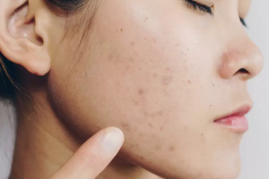 Say Goodbye to Acne Scars: Effective Treatment Options in Singapore