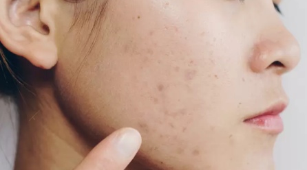 Say Goodbye to Acne Scars: Effective Treatment Options in Singapore