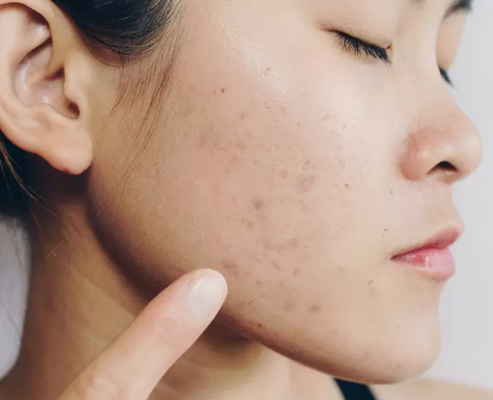 Say Goodbye to Acne Scars: Effective Treatment Options in Singapore