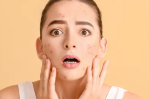 Understanding the Connection Between Stress and Acne