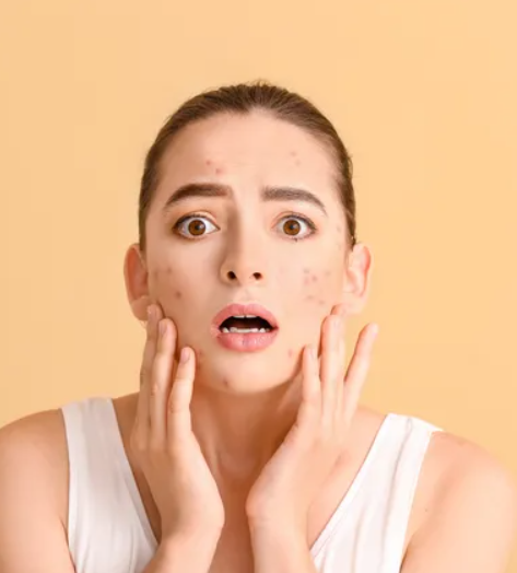 Understanding the Connection Between Stress and Acne