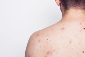 How Body Acne Differs from Facial Acne and How to Treat Them