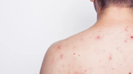 How Body Acne Differs from Facial Acne and How to Treat Them