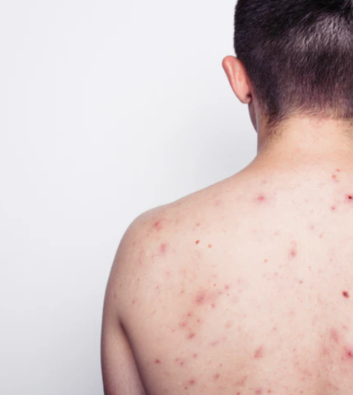 How Body Acne Differs from Facial Acne and How to Treat Them