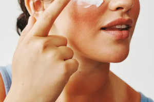 How to Naturally Treat Sunburn and Soothe Your Skin